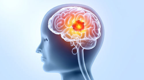Brain Tumor Surgery